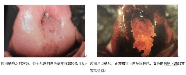 浅谈电子阴道镜作用以及碘反应 浅谈电子阴道镜作用以及碘反应