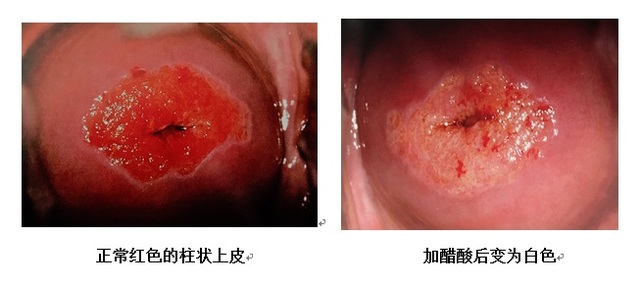 浅谈电子阴道镜作用以及碘反应 浅谈电子阴道镜作用以及碘反应