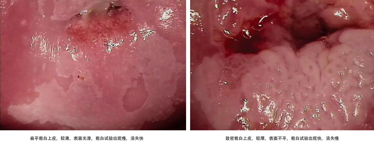 异常阴道镜宫颈图解