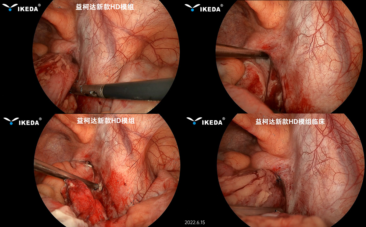 益柯达-新款HD内窥镜模组首次临床