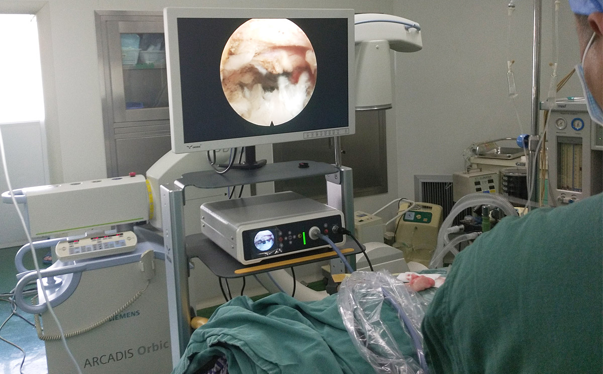 高清内窥镜摄像机在椎间孔镜手术中的精彩表现
