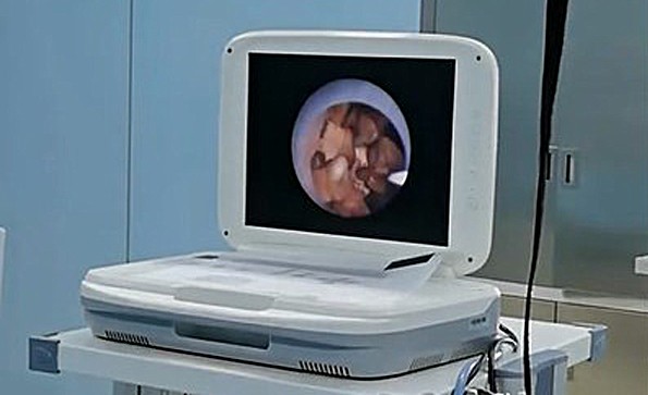 内窥镜摄像机在泌尿科（输尿管镜）的应用